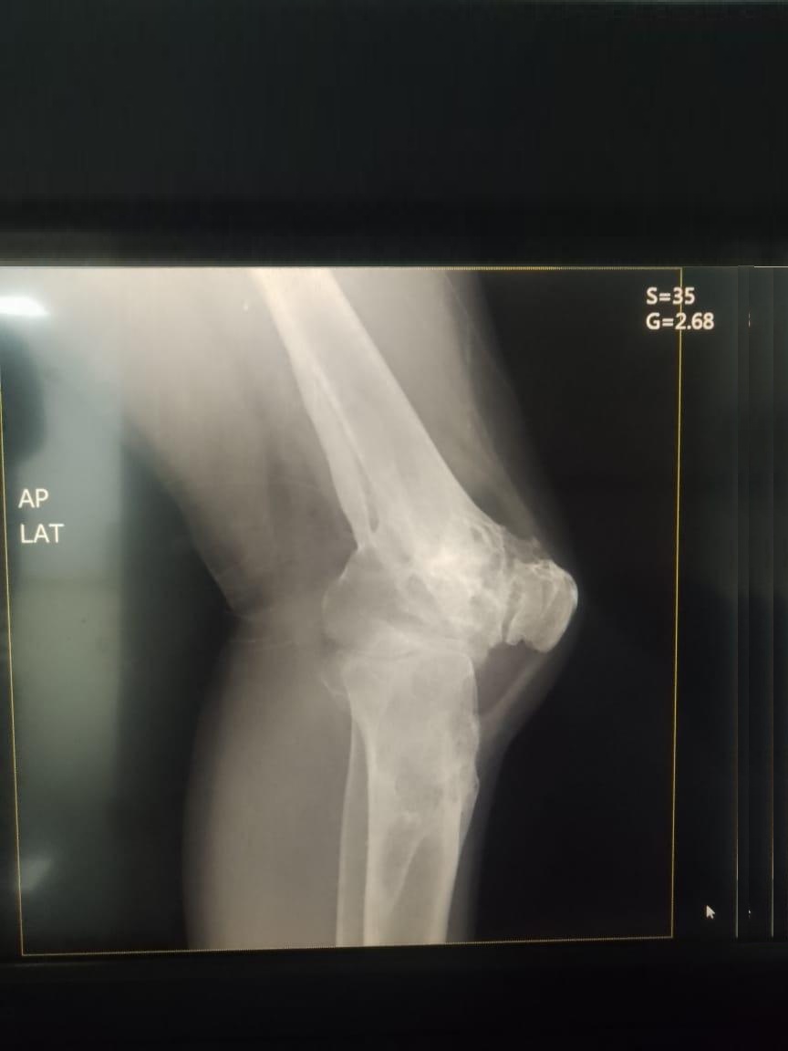 Radiografía preoperatoria de fractura de tibia y osteoartrosis de rodilla